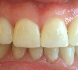zęby pacjenta po i w trakcie leczenia