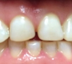 zęby pacjenta przed leczeniem