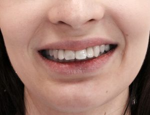 zęby pacjenta po i w trakcie leczenia