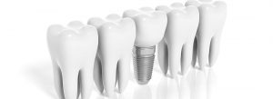rzad implantów zębów