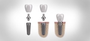 schemat zakładania implantu zęba