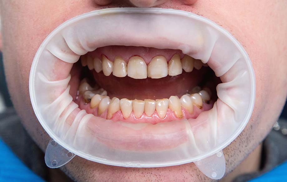 leczeni białych plam na zębach